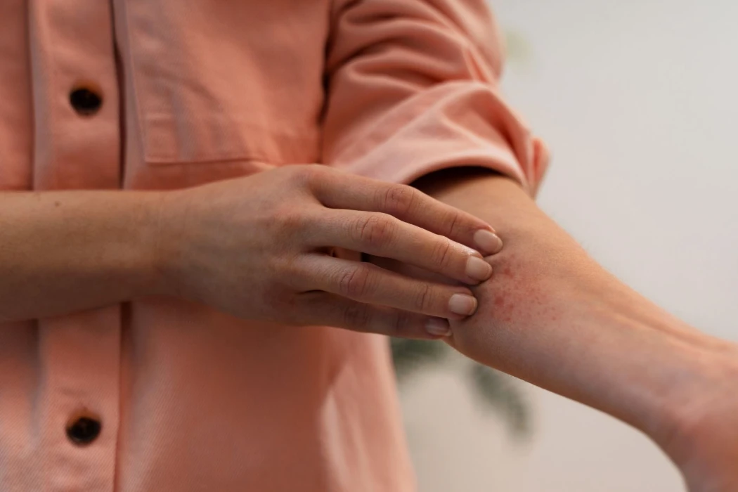 Pharmacy First Impetigo Image